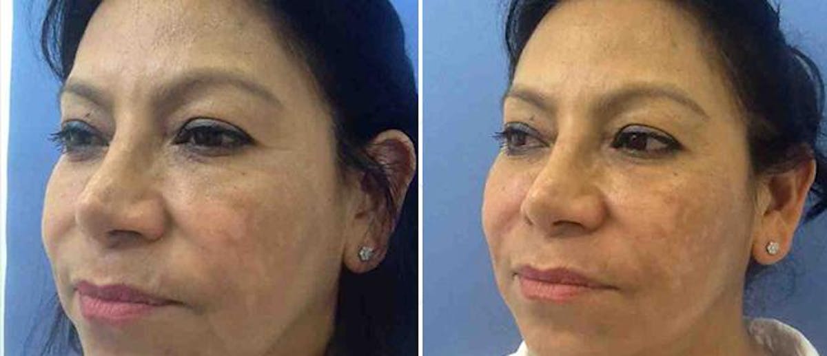 Dermal Fillers Before & After Gallery - Patient 38566864 - Image 1