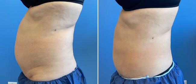 Coolsculpting Before & After Gallery - Patient 38566853 - Image 5