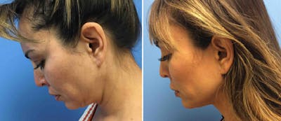 Facetite Before & After Gallery - Patient 38566867 - Image 1