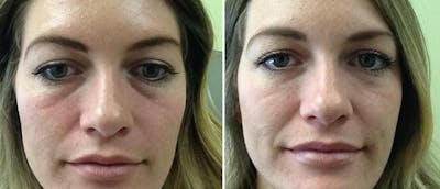 Dermal Fillers Before & After Gallery - Patient 38566866 - Image 1