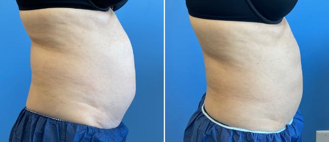 Coolsculpting Before & After Gallery - Patient 38566853 - Image 6