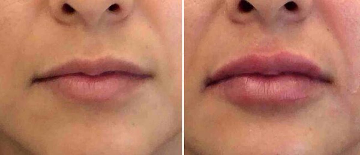 Dermal Fillers Before & After Gallery - Patient 38566870 - Image 1