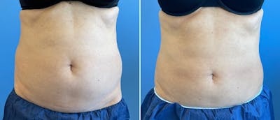 Coolsculpting Before & After Gallery - Patient 38566853 - Image 1