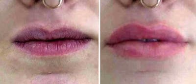 Dermal Fillers Before & After Gallery - Patient 38566872 - Image 1