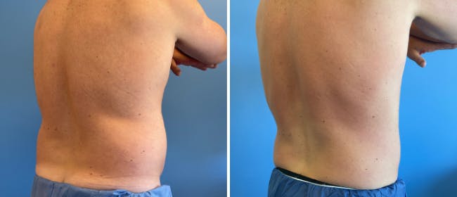 Coolsculpting Before & After Gallery - Patient 38566874 - Image 1