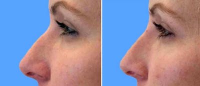 Dermal Fillers Before & After Gallery - Patient 38566873 - Image 1