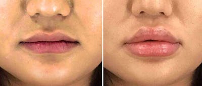 Dermal Fillers Before & After Gallery - Patient 38566875 - Image 1