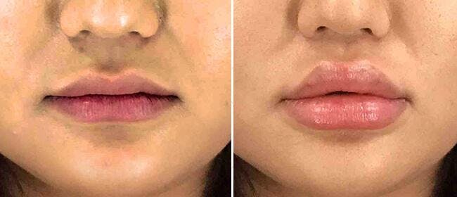 Dermal Fillers Before & After Gallery - Patient 38566875 - Image 1