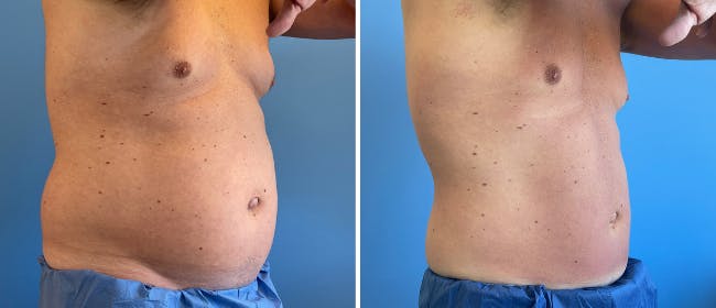 Coolsculpting Before & After Gallery - Patient 38566874 - Image 2