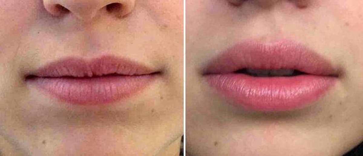 Dermal Fillers Before & After Gallery - Patient 38566877 - Image 1
