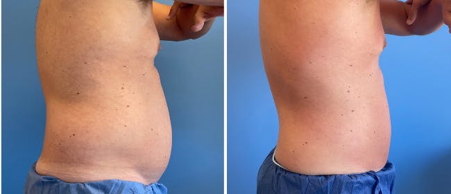 Coolsculpting Before & After Gallery - Patient 38566874 - Image 3