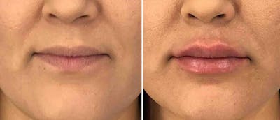 Dermal Fillers Before & After Gallery - Patient 38566880 - Image 1