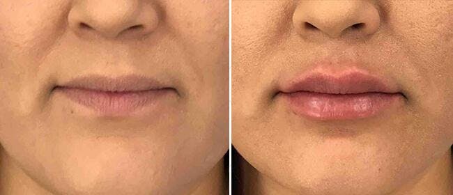 Dermal Fillers Before & After Gallery - Patient 38566880 - Image 1