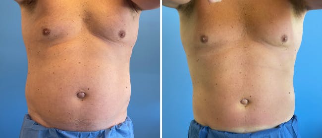 Coolsculpting Before & After Gallery - Patient 38566874 - Image 4