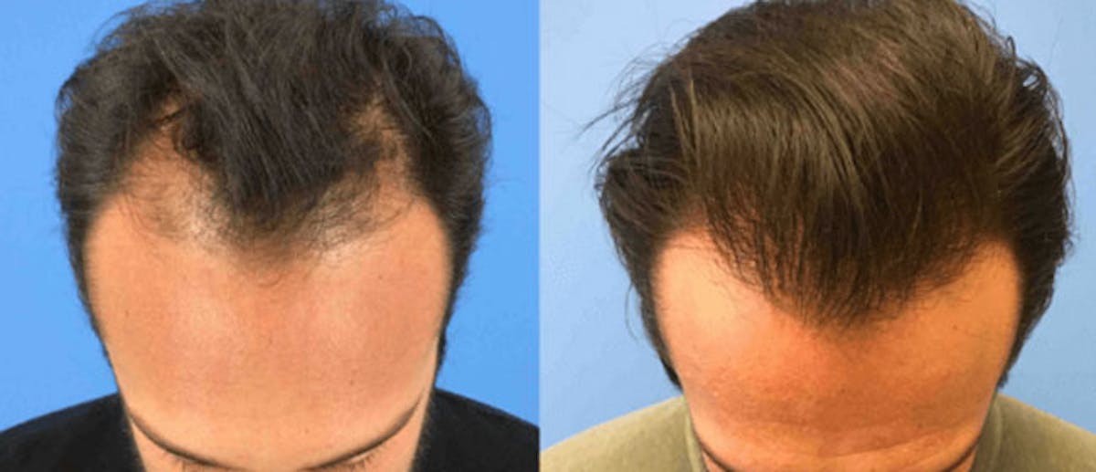 Hair Restoration Before & After Gallery - Patient 38566883 - Image 1
