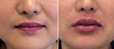 Dermal Fillers Before & After Gallery - Patient 38566882 - Image 1
