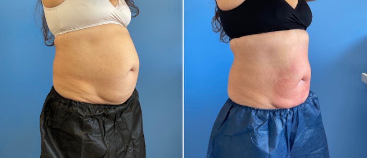 Coolsculpting Before & After Gallery - Patient 38566885 - Image 1