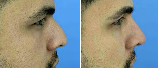 Dermal Fillers Before & After Gallery - Patient 38566884 - Image 1