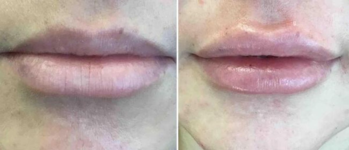 Dermal Fillers Before & After Gallery - Patient 38566886 - Image 1
