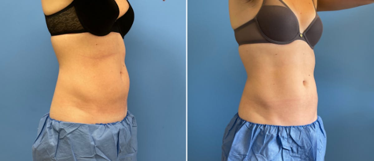 Coolsculpting Before & After Gallery - Patient 38566887 - Image 1