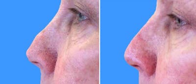 Dermal Fillers Before & After Gallery - Patient 38566888 - Image 1