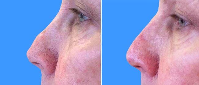 Dermal Fillers Before & After Gallery - Patient 38566888 - Image 1