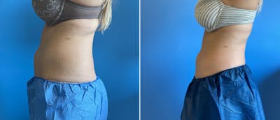 Coolsculpting Before & After Gallery - Patient 38566889 - Image 1