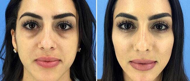 Dermal Fillers Before & After Gallery - Patient 38566890 - Image 1