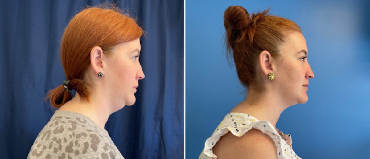 Coolsculpting Before & After Gallery - Patient 38566892 - Image 1