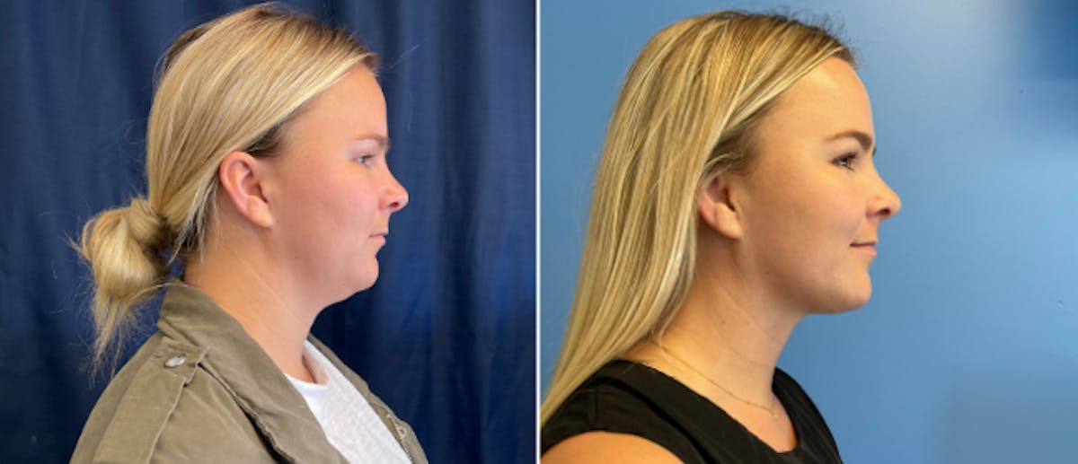 Coolsculpting Before & After Gallery - Patient 38566895 - Image 1