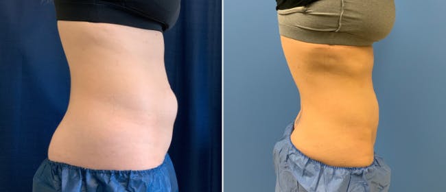 Coolsculpting Before & After Gallery - Patient 38566897 - Image 1