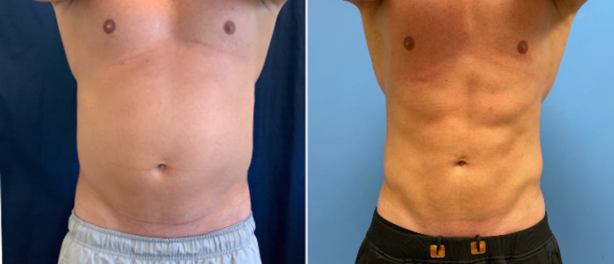 Coolsculpting Before & After Gallery - Patient 38566899 - Image 1