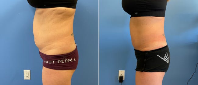 Coolsculpting Before & After Gallery - Patient 38566900 - Image 1