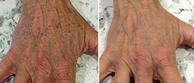 IPL Before & After Gallery - Patient 38566902 - Image 1