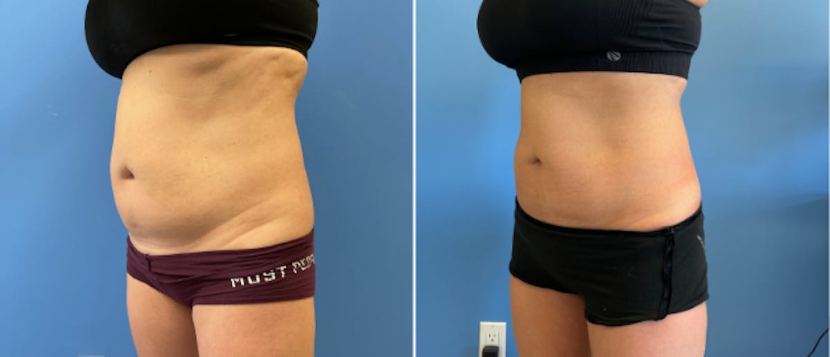 Coolsculpting Before & After Gallery - Patient 38566900 - Image 2