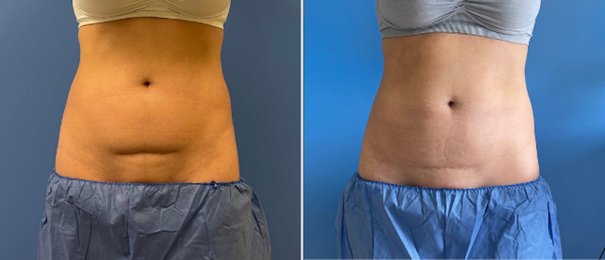 Coolsculpting Before & After Gallery - Patient 38566906 - Image 1