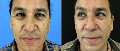 IPL Before & After Gallery - Patient 38566905 - Image 1