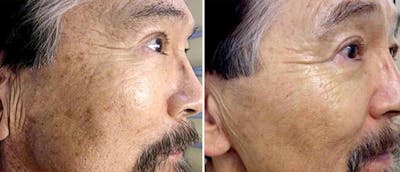 IPL Before & After Gallery - Patient 38566907 - Image 1