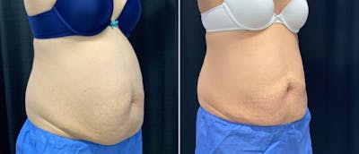 Coolsculpting Before & After Gallery - Patient 38566908 - Image 1
