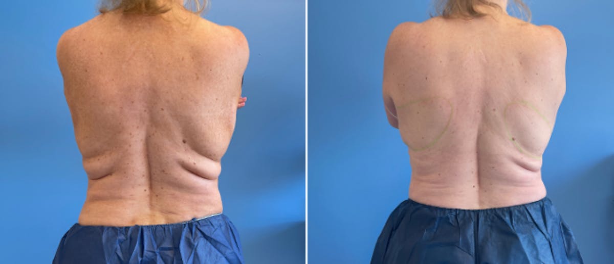 Coolsculpting Before & After Gallery - Patient 38566909 - Image 1