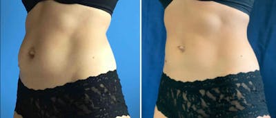 Coolsculpting Before & After Gallery - Patient 38566910 - Image 1