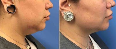 Kybella Before & After Gallery - Patient 38566911 - Image 1