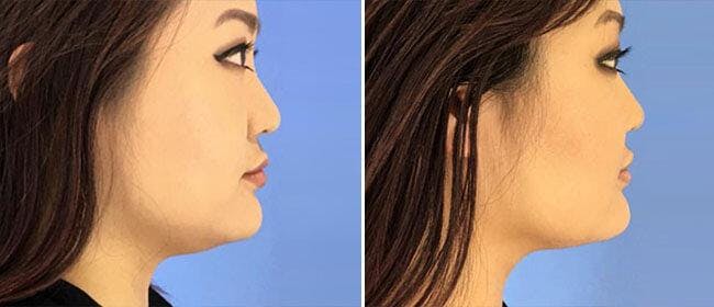 Kybella Before & After Gallery - Patient 38566913 - Image 1