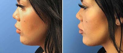 Kybella Before & After Gallery - Patient 38566915 - Image 1