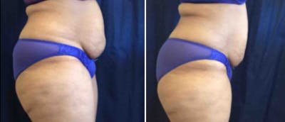 Coolsculpting Before & After Gallery - Patient 38566914 - Image 1