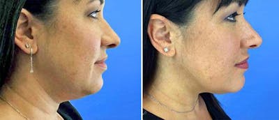 Kybella Before & After Gallery - Patient 38566916 - Image 1