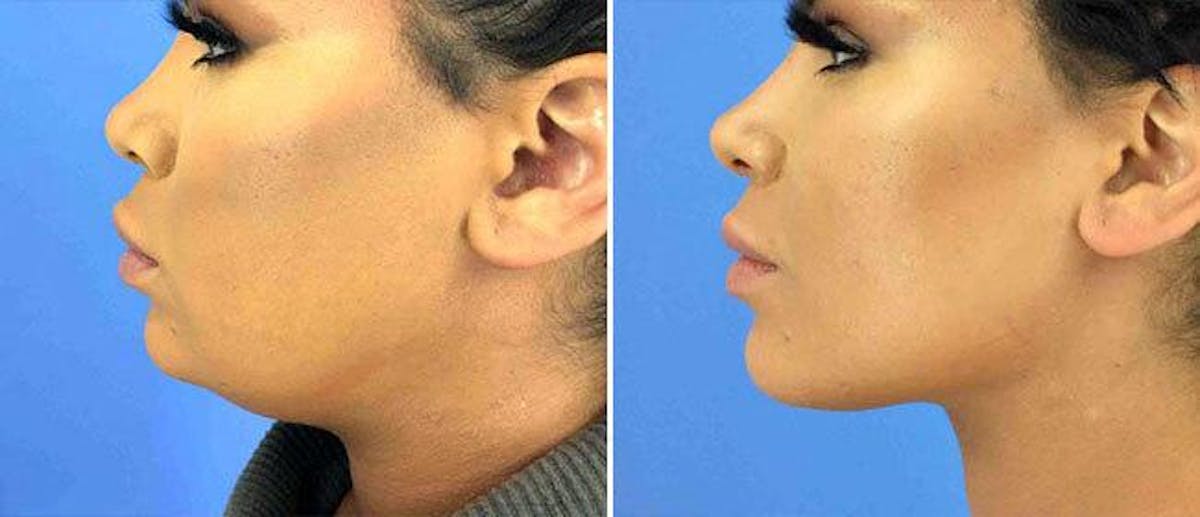 Kybella Before & After Gallery - Patient 38566918 - Image 1