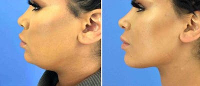 Kybella Before & After Gallery - Patient 38566918 - Image 1