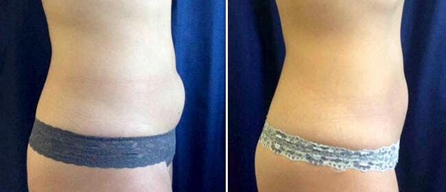 Coolsculpting Before & After Gallery - Patient 38566919 - Image 1