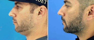 Kybella Before & After Gallery - Patient 38566921 - Image 1